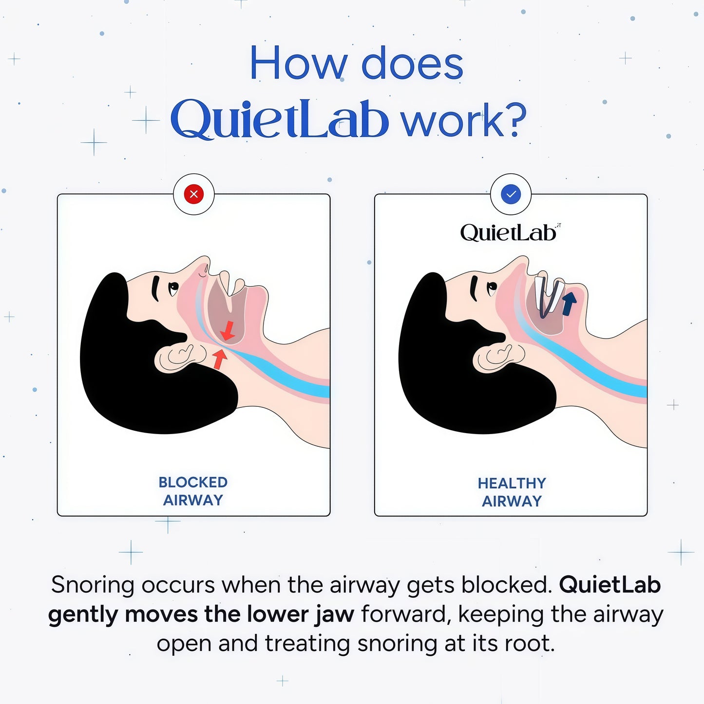 QuietLab Pro Anti-Snoring Mouthpiece